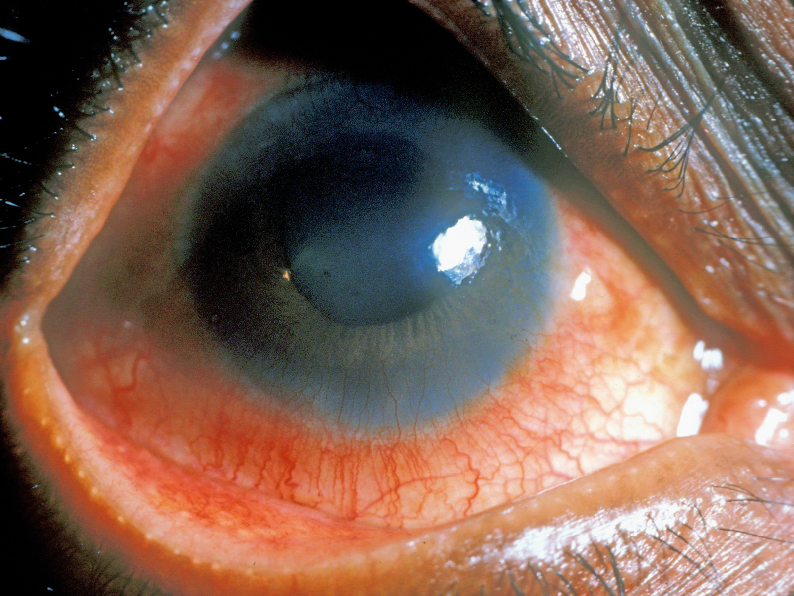 Anterior Uveitis
