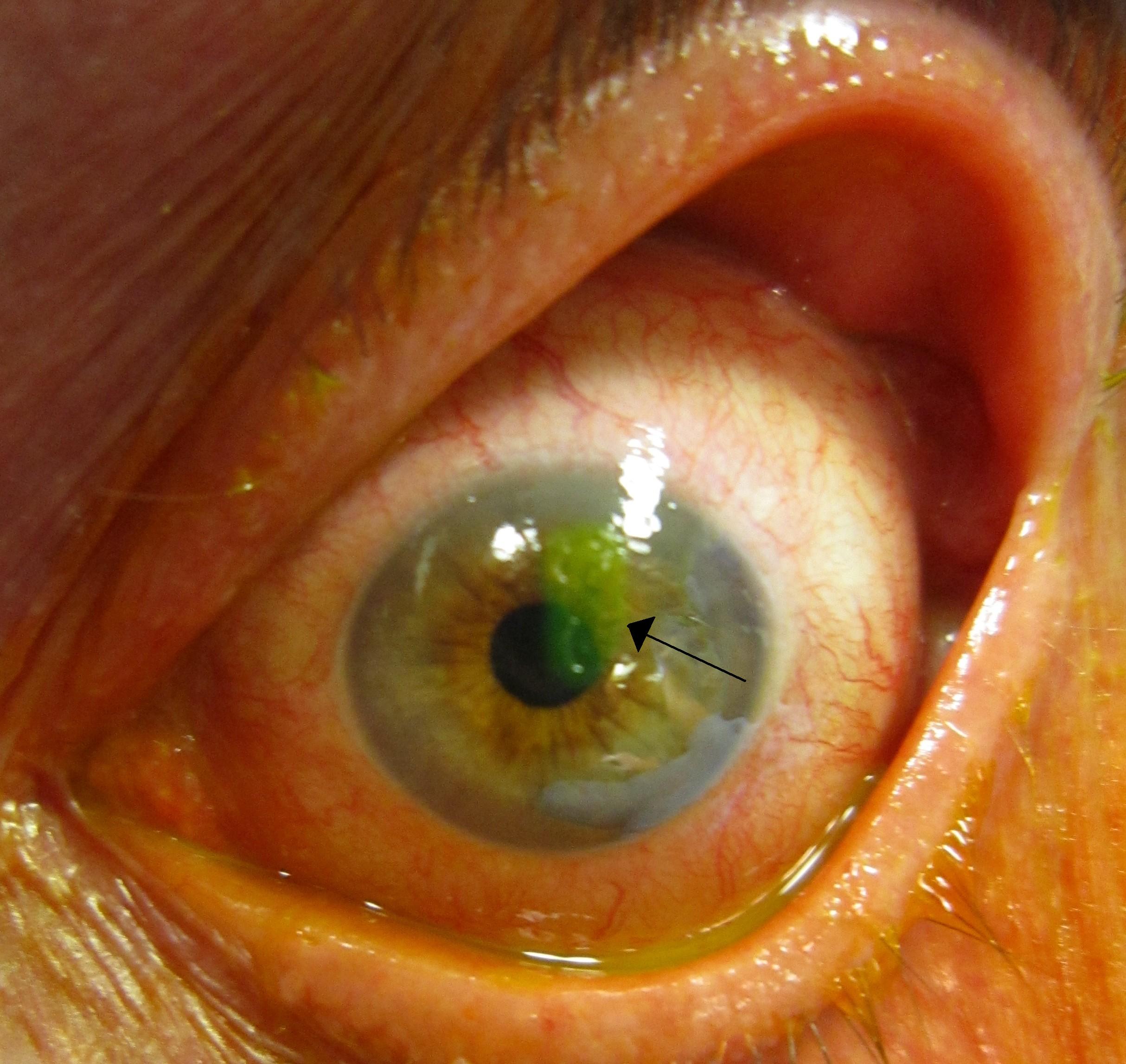 Recurrent Corneal Erosions